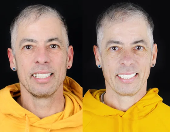 example of dental crowns used in a full smile makeover in Mexico