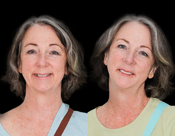 cost of dental implants in Cancun, Mexico before and after