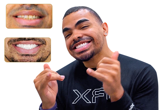 can I get zirconia veneers