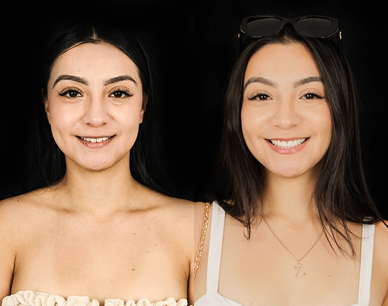 cost of dental veneers in Mexico, before and after