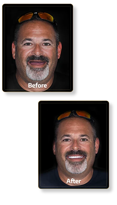 before and after result in Cancun Dental Design