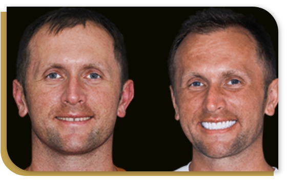 teeth shaving for veneers