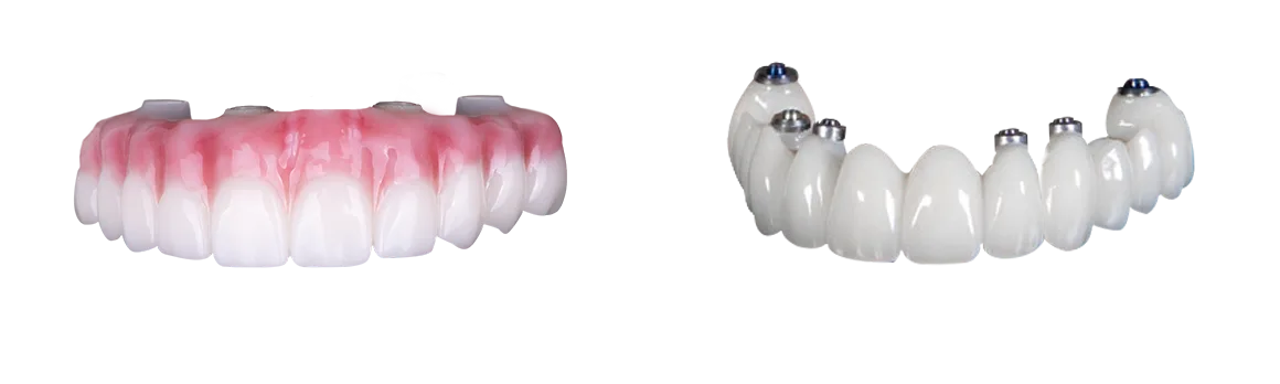 3 on 6 versus all on 4 dental implants