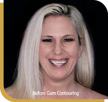 dental bone graft implant