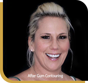 dental bone graft implant