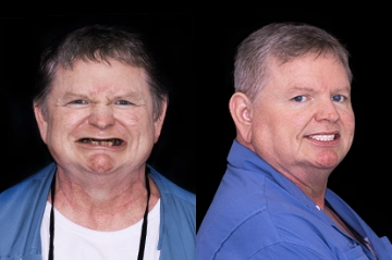 patient with all on 4 fixed hybrid in mexico