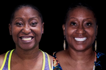 patient with all on 4 zirconia bridge in mexico