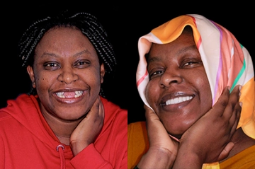 patient with all on 5 zirconia bridge in mexico