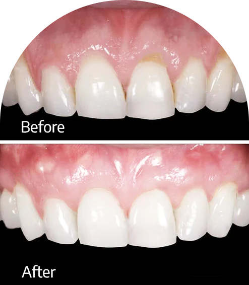 dental bone graft cost mexico