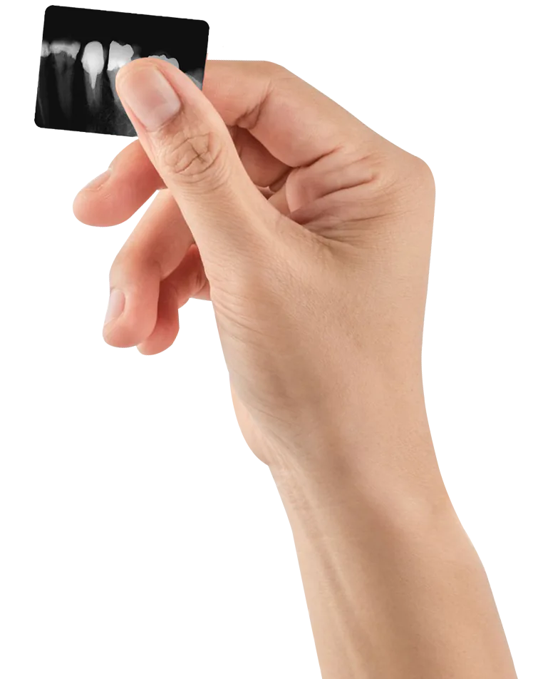 dentist hand holding a patient´s tooth x-ray after a root canal restoration