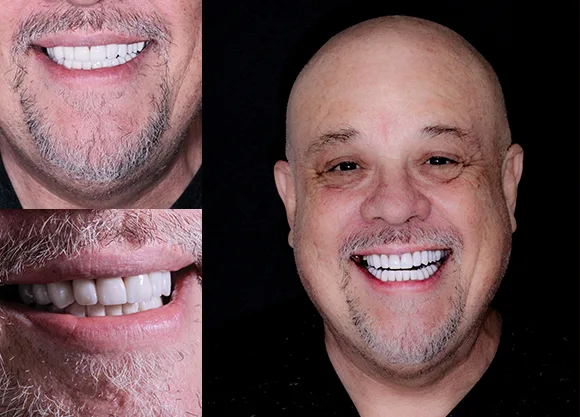 zirconia crowns before and after photos