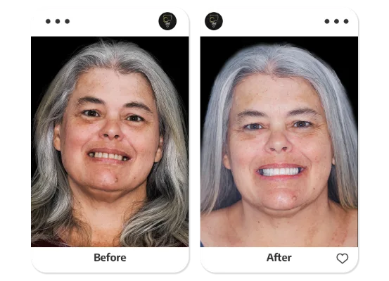 young woman patient of cancun dental design smiling with her all on 4 dental implants