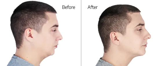 underbite surgery before and after pictures of a patient at cancun dental design