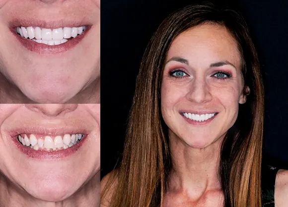 emax dental crowns before and after photos