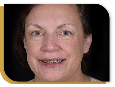 Before and after Snap On Denture