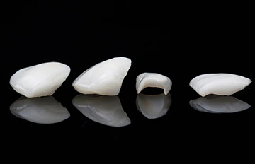 example of dental veneers used in a full smile makeover in Mexico