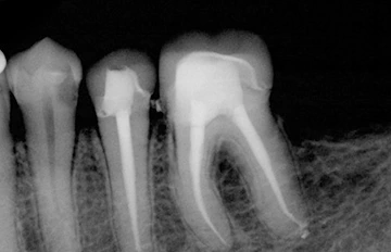 root canal x-ray caption from a full smile makeover in Mexico