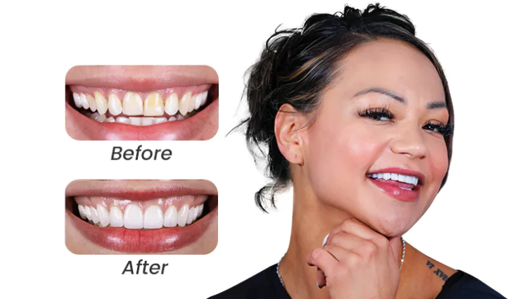 female patient at cancun dental design snmiling after getting a full set of veneers