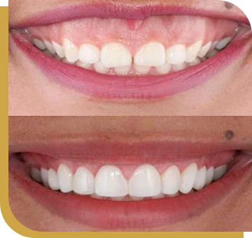 Cancun dental design´s patient before and after gum contouring
