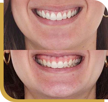 Cancun dental design´s patient before and after gum contouring