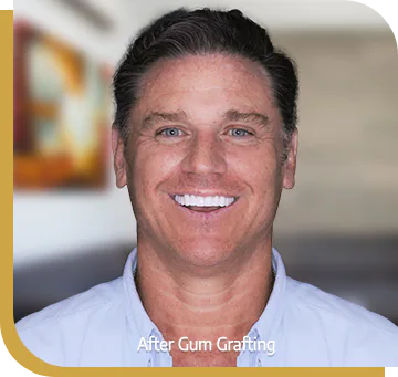 gum contouring guidelines