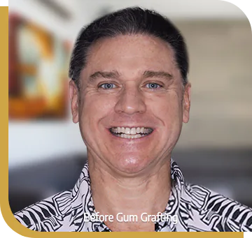 gum contouring guidelines