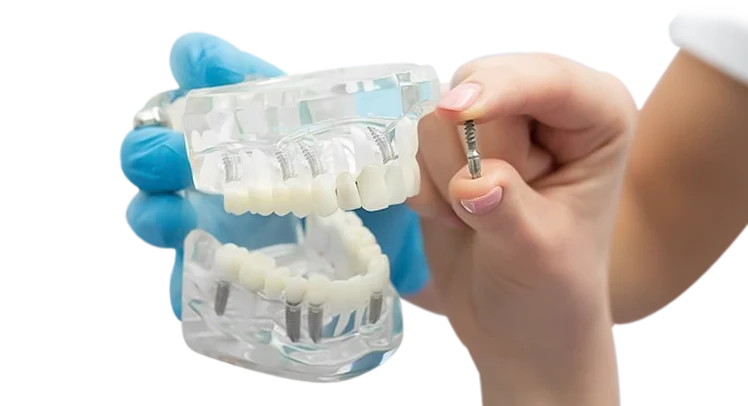 how long does 3-on-6 implants last?