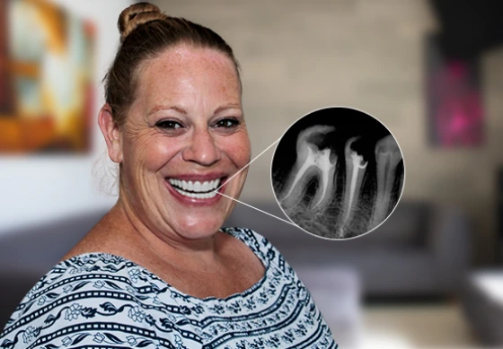 X-ray caption of a cancun dental design clinic patient who got root canal therapy