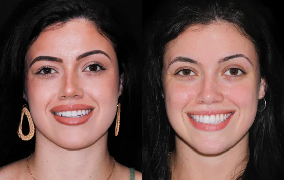 before and after result, invisalign treatmentin cdd