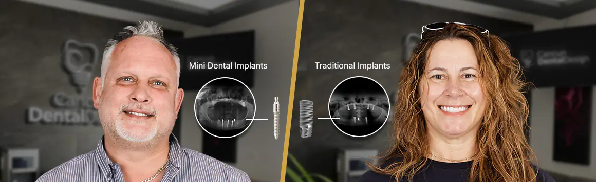 mini dental iImplants vs traditional dental implants