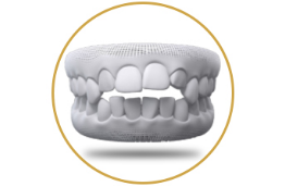 Open bite maloclussion for orthognathic surgery