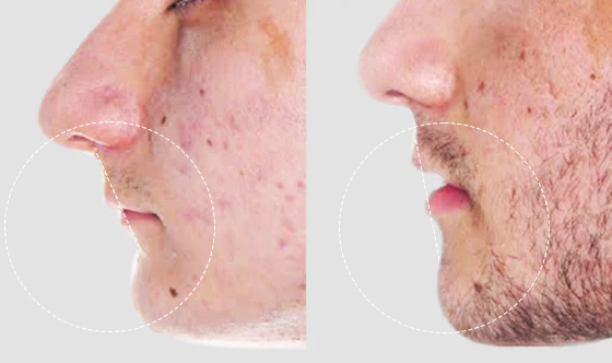 Overbite surgery before and after of a cancun dental desing n´s young male patient