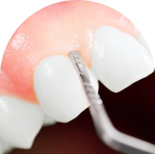 pinhole surgery in Mexico