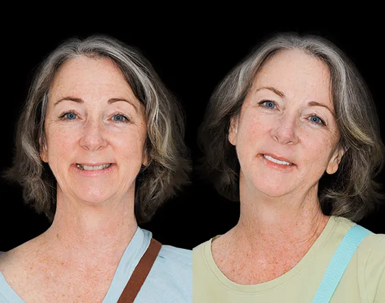 cancun dental design patients smile makeover before and after pictures
