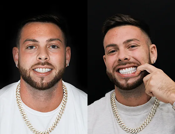 cancun dental design patients smile makeover before and after pictures