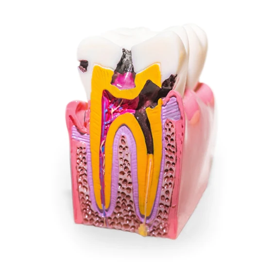 elder patient at Cancun Dental Design smiling after his root canal treatment