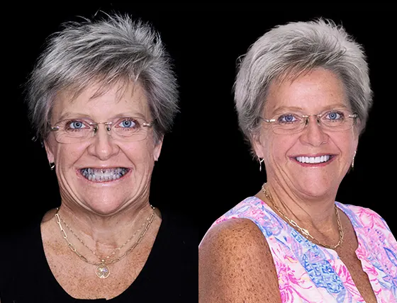 cancun dental design patients smile makeover before and after pictures