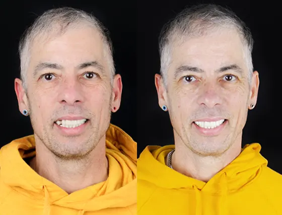 cancun dental design patients smile makeover before and after pictures