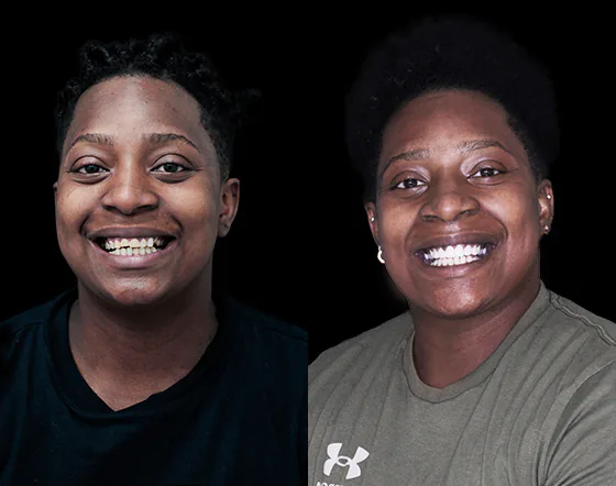 zoom teeth whitening LED lamp used in a full smile makeover in Mexico