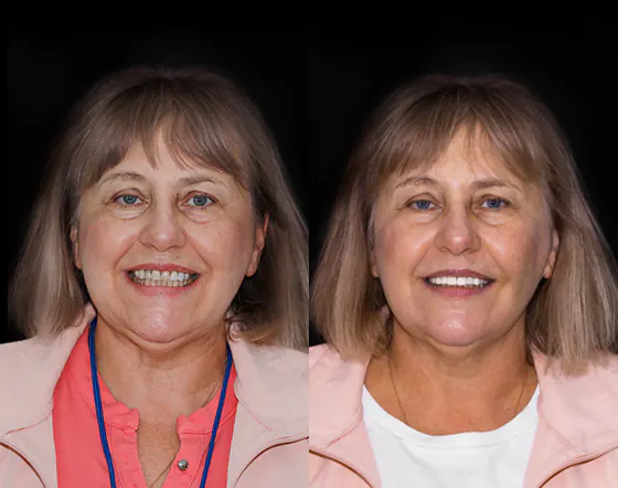 example of dental veneers used in a full smile makeover in Mexico