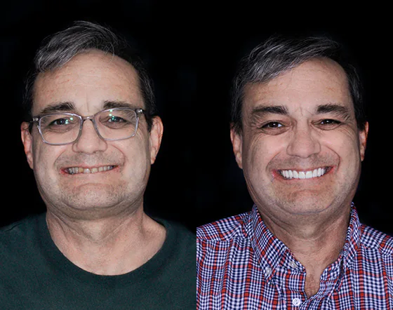 example of invisalign braces used in a full smile makeover in Mexico