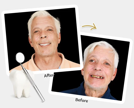 cancun dental design´s patient before and after pictures of his treatment with snap in dentures