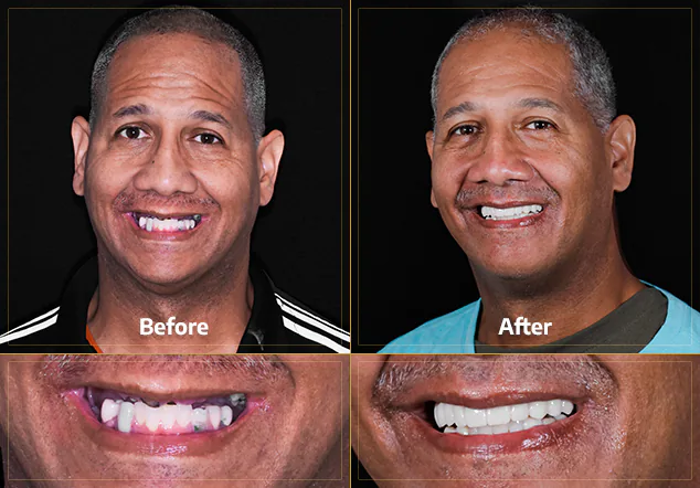 Snap-on denture before and after in mexico