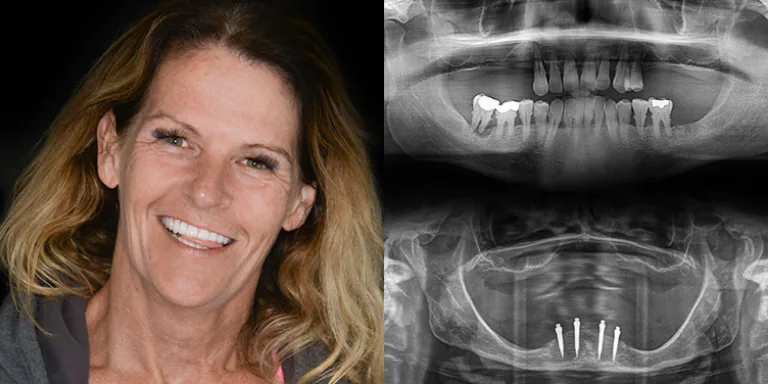 mini dental iImplants vs traditional dental implants