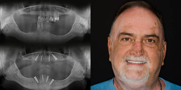 mini dental iImplants vs traditional dental implants