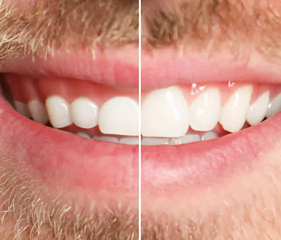 gum contouring guidelines