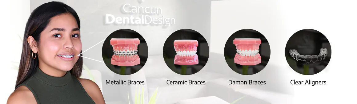 types of braces in cancun mexico