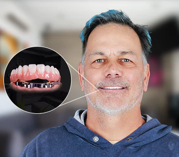 X ray of a patient implant-fixed dental bridge