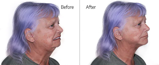 underbite surgery before and after pictures of a patient at cancun dental design