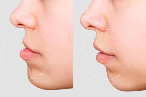 Overbite surgery before and after of a cancun dental desing n´s young male patient